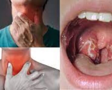 How To Get Rid of a Sore Throat
